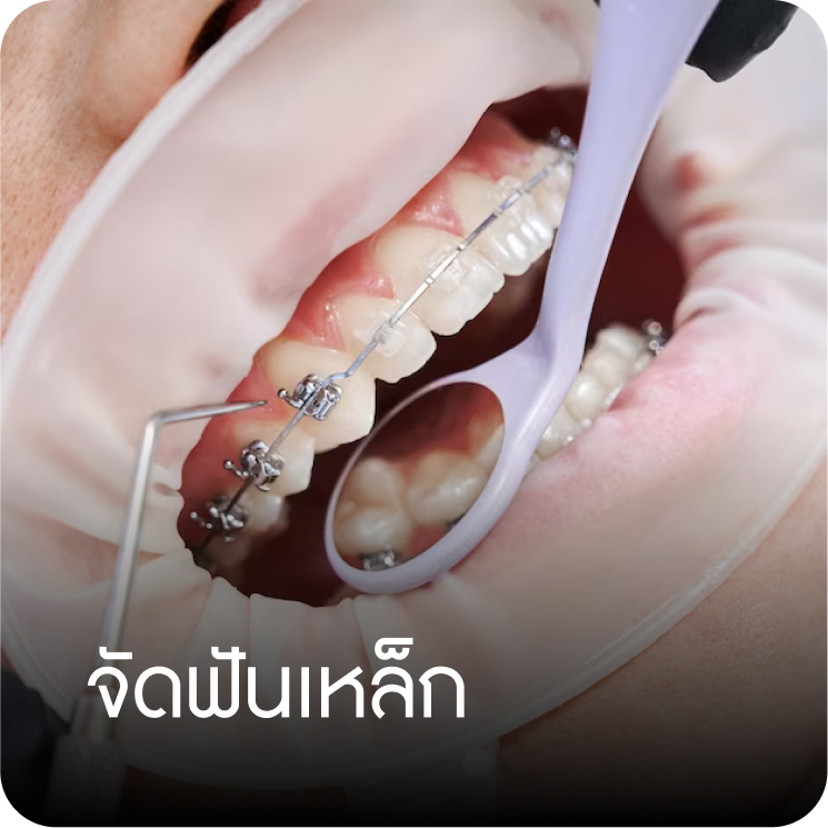 จัดฟันเหล็ก คลินิกทันตกรรมบ้านสวน