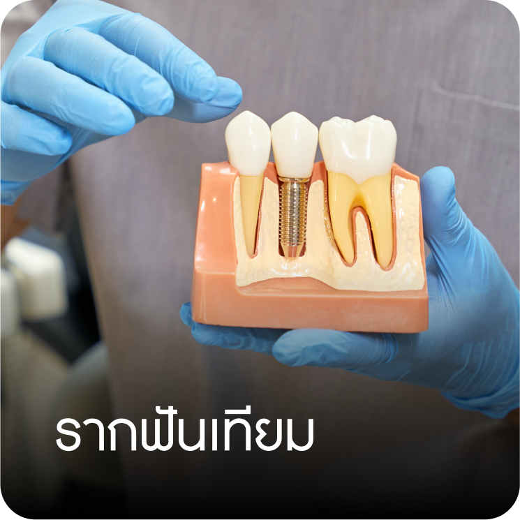 รากฟันเทียม คลินิกทันตกรรมบ้านสวน