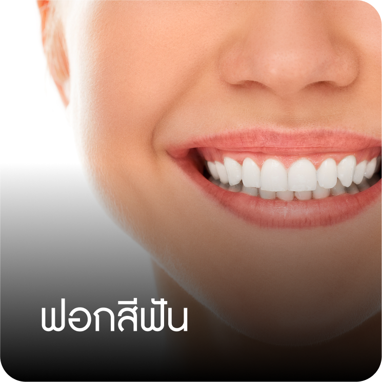 ฟอกสีฟัน คลินิกทันตกรรมบ้านสวน