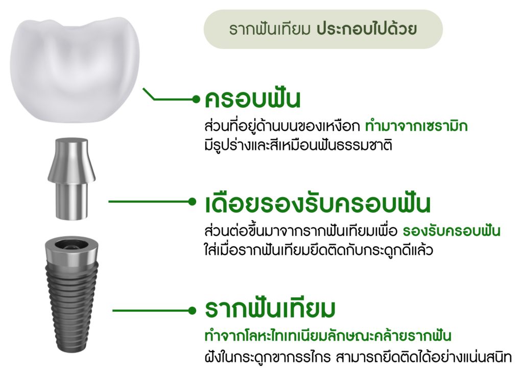 รากฟันเทียม ประกอบด้วย